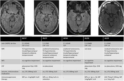 Autoimmune Encephalitis in Late-Onset Seizures: When to Suspect and How to Treat